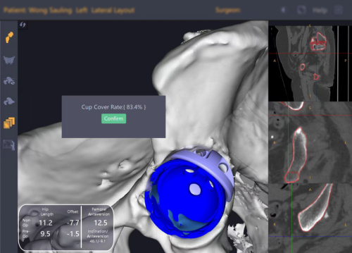 港医疗团队利用深圳锟铻®机器人重建复杂髋关节