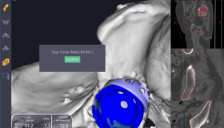 港医疗团队利用深圳锟铻®机器人重建复杂髋关节 