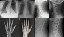 警惕AI深度伪造X光片以假乱真 